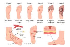 Image result for IDSA Diabetic Foot Wound Classification