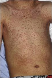 Infectious mononucleosis is characterized by swollen lymph glands, fever, sore throat, and extreme fatigue. Cutaneous Eruptions Associated With Antimicrobials In Patients With Infectious Mononucleosis The American Journal Of Medicine