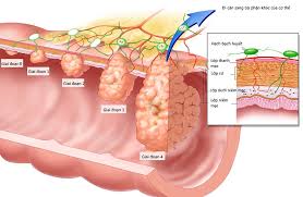 Vì thế để bảo vệ sức khỏe cũng như ngăn ngừa các bệnh lý. Ung ThÆ° Trá»±c Trang La Gi Nguyen Nhan Triá»‡u Chá»©ng Cach Ä'iá»u Trá»‹