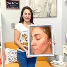 Emilie Duke Acne Specialist l Loudoun Acne Clinic l E SKIN Forté