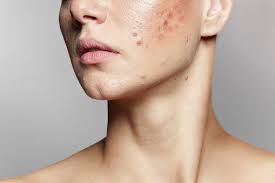 A Young Woman With Bad Skin Skin With A Lot Of Pimples Acne Disease Acne Treatment Stock Photo - Download Image Now - iStock