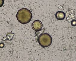 Calcium Carbonate Black Arrows Amorphous Smaller Crystals In Background Unknown Flat Plates Arrowheads Crystals Urinal Calcium Carbonate