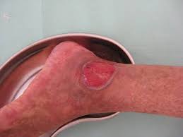 Related online courses on physioplus. Medical Blogs Contains Disease Drugs Ingredients Blog Healthcare News