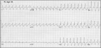 Ecg Learning Center An Introduction To Clinical Electrocardiography Salvo's signed book and £25 gift voucher. ecg learning center an introduction