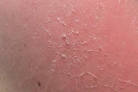 Measles is an acute respiratory infectious disease caused by measles virus. Desquamation Wikipedia
