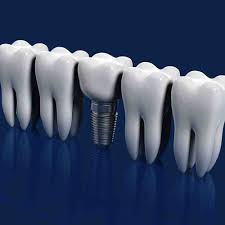 Saving veterans & their families money on dental care. Will The Va Pay For Dental Implants Dental News Network