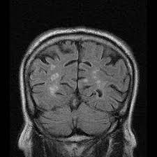 Leukenzephalopathie