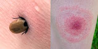 … the process of consuming and eating a spider digests the proteins in the venom. Bug Bites Pictures Symptoms Treatment And Prevention