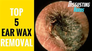 Ear wax removal sutton coldfield. Dry Ear Wax Removal Shefalitayal