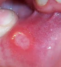 To get rid of cold sores quickly, you can take medications from drugstore, prescription drugs, or utilizing alternative medical treatments used to treat cold sores. Mouth Ulcers In Children Children S Hospital Colorado