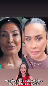 Reversão de intercorrências de preenchimento de olheira vindo de outro...