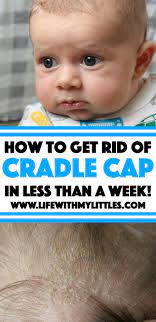 Then wash the hair as usual and brush the scalp lightly with a soft brush to loosen the scale. How To Get Rid Of Cradle Cap Life With My Littles