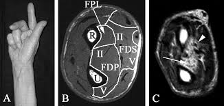 The right hand of the examiner gives resistance to determine which grade the muscle can be given. Finger Flexor Weakness In Inclusion Body Myositis Neurology