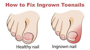 How To Fix Ingrown Toenails Quickly And Easily Ingrown Toe Nail Treating Ingrown Ingrown Nail