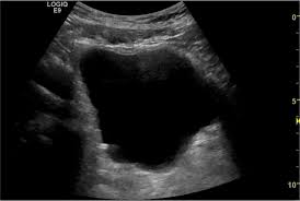 Bladder Stone Case 1 Litfl Ultrasound Clinical Cases