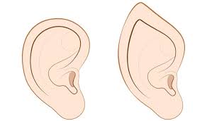 Elf Ear Los Angeles Ent Doctor