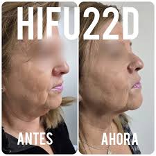 Hifu Facial