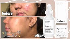Paula's choice is more versatile. I Used The Ordinary Niacinamide 10 Zinc 1 Serum For 1 Month Review Youtube