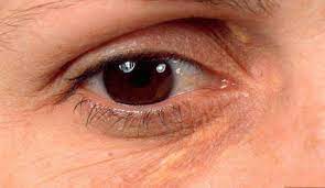 Gelb Um Die Augen Ursachen Und Behandlung