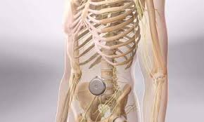 Image result for Intrathecal Pump