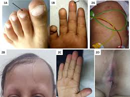 The medications most commonly used to control lupus include: 18 An Uncommon Overlap Of Two Common Rheumatological Disorders Lupus Science Medicine