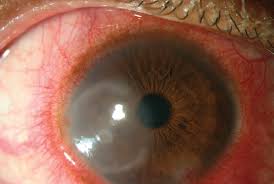 Image result for Acute Red Eye