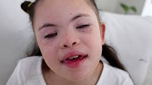 Rio is a blind child with Down syndrome who loves making new friends and  telling jokes. She's full of energy, constantly flapping her hands and  rocking back and forth as she stims