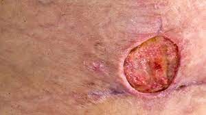 Before your appointment, you might want to write a list that includes: Mrsa Staph Infection Pictures Symptoms Treatment And Prevention