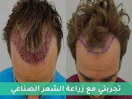 تجربتي مع زراعة الشعر الصناعي in 2021 hair beauty hair styles