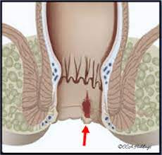 A fissure is considered chronic if it lasts more than eight weeks. Colorectal Clinic Associates