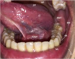 Image result for spinocellular carcinoma of the oral cavity