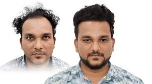 Effective Hair Transplant in Mumbai: Expert Surgeons, Advanced Techniques