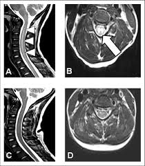 In pediatric patients, widening of the . The Patient S Cervical Magnetic Resonance Imaging Mri At Admission Download Scientific Diagram