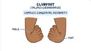 Image result for Clubfoot