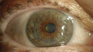 Keratoplastik Bei Hornhautentzundung Oder Verletzung