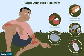 Image result for Atopic eczema atopic dermatitis