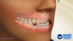 More often than not, metal braces are preferred to treat. How To Fix Underbite With Braces Youtube