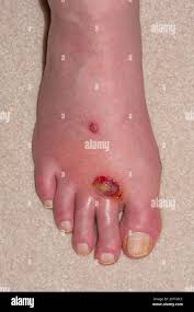 Image result for Trombicula autumnalis bites