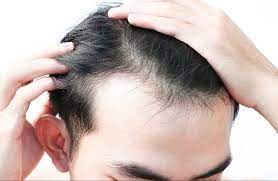 Tentu secara alamiah akan terjadi peremajaan. Ini Gejala Rambut Rontok Pada Pria Yang Wajib Kamu Ketahui Bukareview