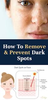 How To Lighten Dark Spots Capital Hair And Beauty Lighten Dark Spots Dark Spots