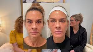 Aesthetics is a journey! Listen to how Linda followed the plan and is now  the best of version of herself with a boost in confidence and natural  beauty!