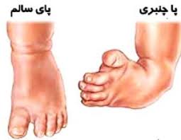Image result for ‫درمان چنبری پا‬‎