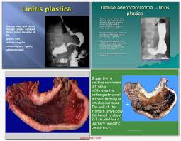 Linitis Plastica Leather Bottle Stomach Borman Stage 4 Gastric Carcinoma Diffusely Infiltrates Gastric W Gastric Carcinoma Ultrasound Sonography Ultrasound