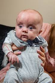 Baby born without any skin