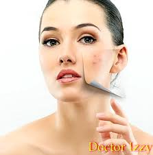 Masalah whitehead dan blackhead boleh dikatakan antara situasi kedua selepas jerawat, yang jadi, apakah rutin yang korang boleh buat untuk hilangkan masalah whitehead dan blackhead ini? Soda Bikarbonat Untuk Kulit Berjerawat