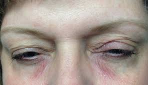 In other cases it takes a few hours. Derm Dx Itchy Rash On The Eyelid Clinical Advisor