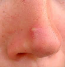 How dermatologists really get rid of whiteheads. Nose Acne Causes Treatment And Remedies