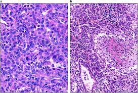 Population based epidemiology and prognosis of mesothelioma in leeds, uk. Nuclear Grade And Necrosis Predict Prognosis In Malignant Epithelioid Pleural Mesothelioma A Multi Institutional Study Modern Pathology