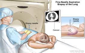 Early on in the disease, people with lung cancer may not have any symptoms. Non Small Cell Lung Cancer Hematology Oncology Associates Of Cny