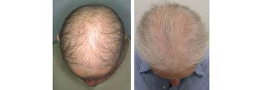 L'alopezia diffusa hè una di e forme d' alopecia , in quale a voglia intensa di u l'alopezia telogenosa diffusa hè diagnosticata più spessu. Arztinformationen Hair Nail